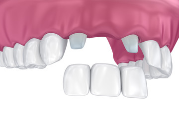 pròtesis dental